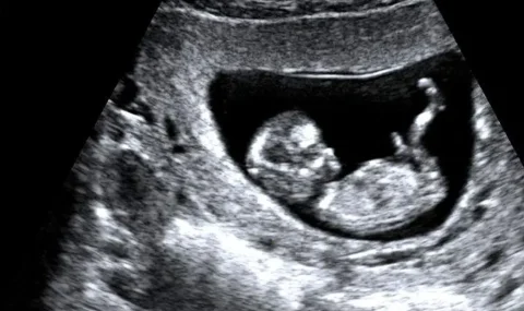 11-14 Hafta Ultrasonografisi